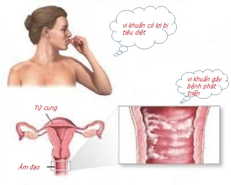 Viêm âm đạo ở nữ giới: nguyên nhân, triệu chứng và cách điều trị 1