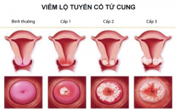 chua-benh-viem-lo-tuyen-co-tu-cung-bang-cay-thuoc-nam
