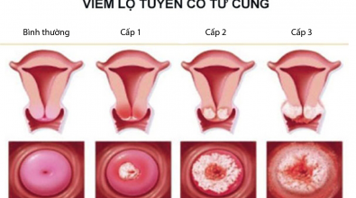 chua-benh-viem-lo-tuyen-co-tu-cung-bang-cay-thuoc-nam