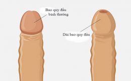 dai-bao-quy-dau-la-gi-nguyen-nhan-bieu-hien-va-cach-dieu-tri