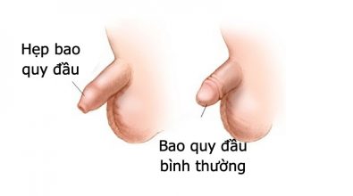 hep-bao-quy-dau-nguyen-nhan-trieu-chung-va-cach-dieu-tri
