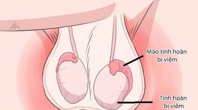 nguyen-nhan-gay-viem-tinh-hoan-nam-gioi-nen-biet