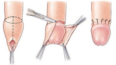 quy-trinh-cat-bao-quy-dau-nhu-the-nao