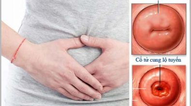 viem-lo-tuyen-co-tu-cung-co-thai-duoc-khong