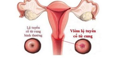 benh-viem-lo-tuyen-co-tu-cung-nguyen-nhan-trieu-chung-cach-dieu-tri