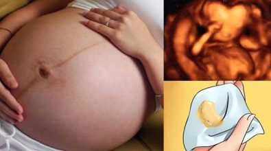 viem-am-dao-3-thang-dau-thai-ky-phai-lam-sao-chua-nhu-the-nao